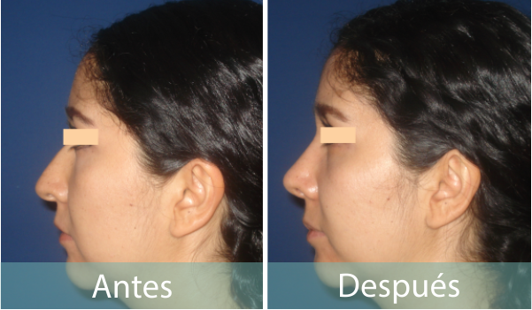 Fotos Antes y Despues